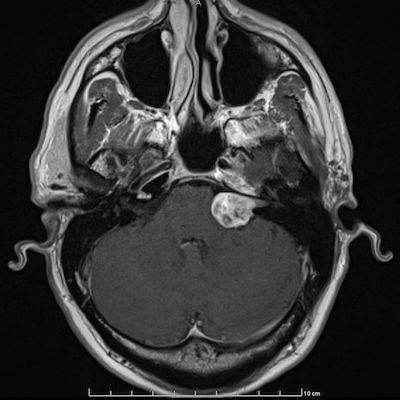 снимок МРТ внутреннего уха